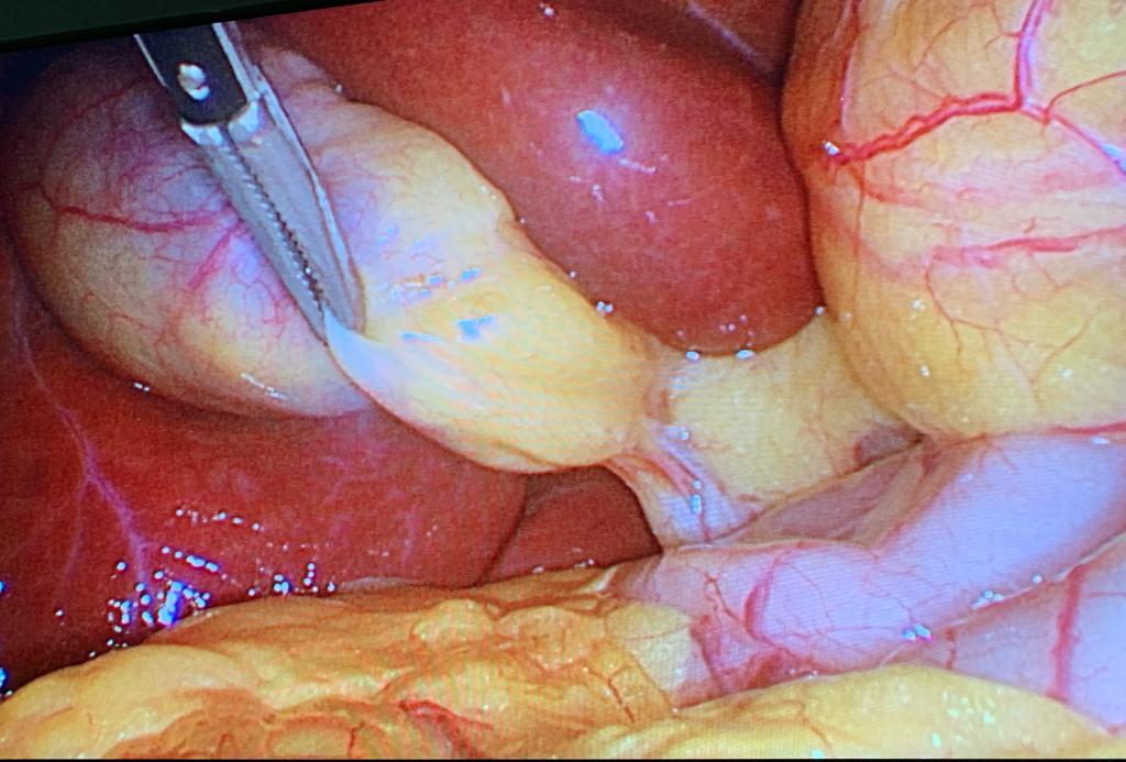 Webinario: Cirugía Hepato-Pancreato-Biliar