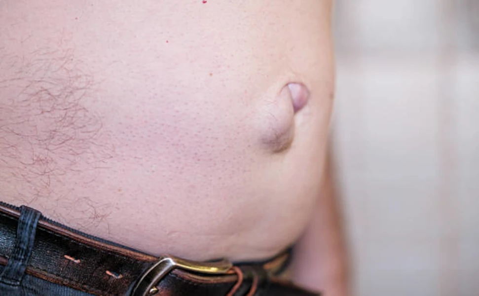 📢 Webinario “Endolich: La nueva era en el tratamiento de la recidiva herniaria laparoscópica” | Lunes 03/10